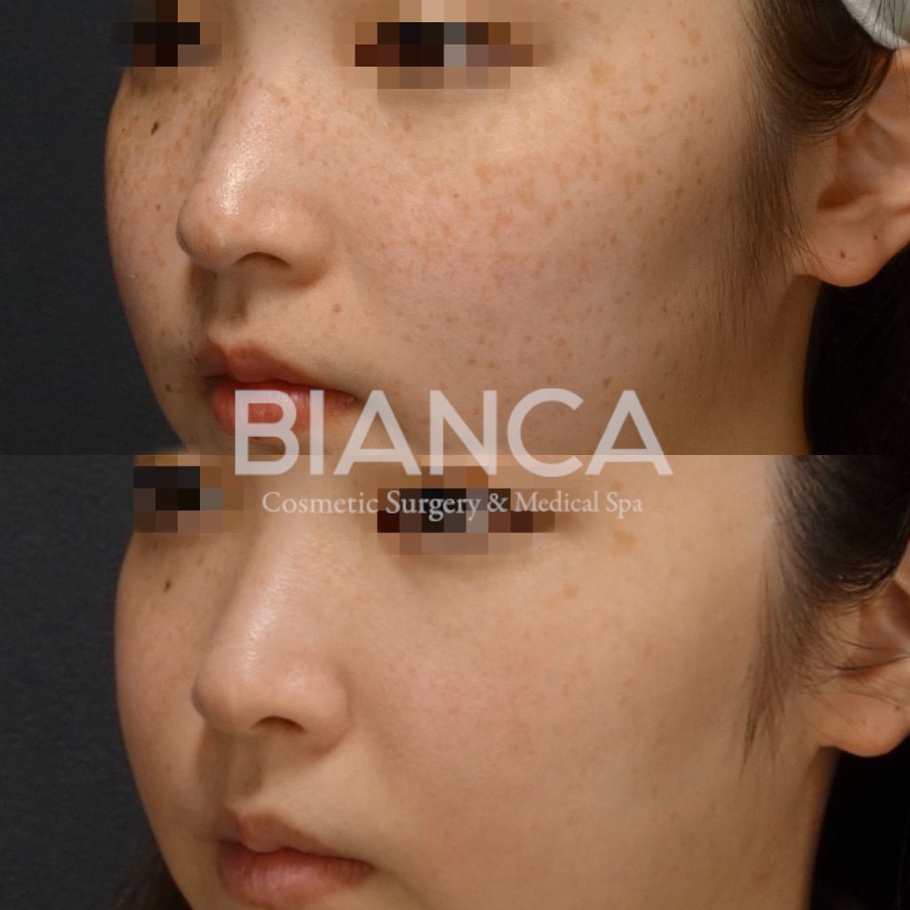 PICO SPOT（ピコスポット）＋ピコトーニングによるそばかす治療症例