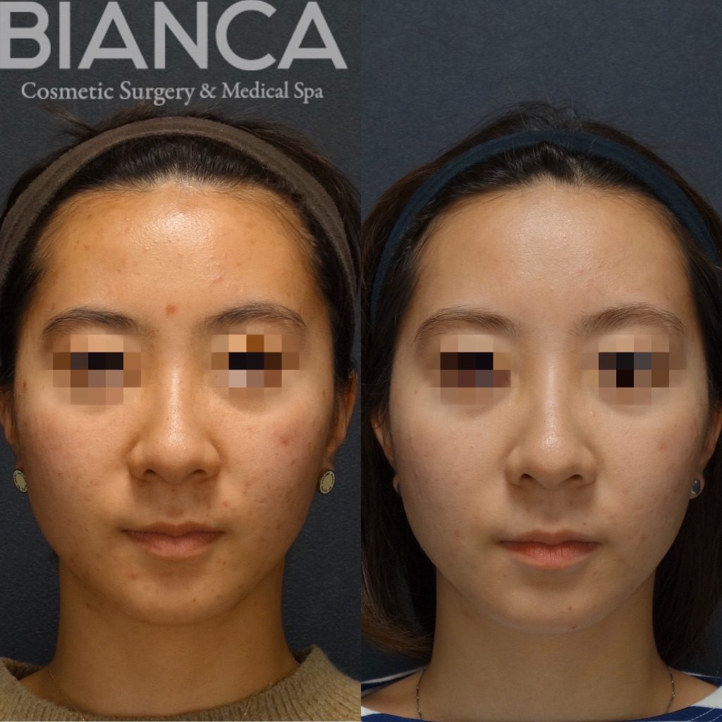 ハイドラフェイシャル（Hydrafacial）×ロアキュタン（イソトレチノイン）によるニキビ治療の症例写真・ビフォーアフター