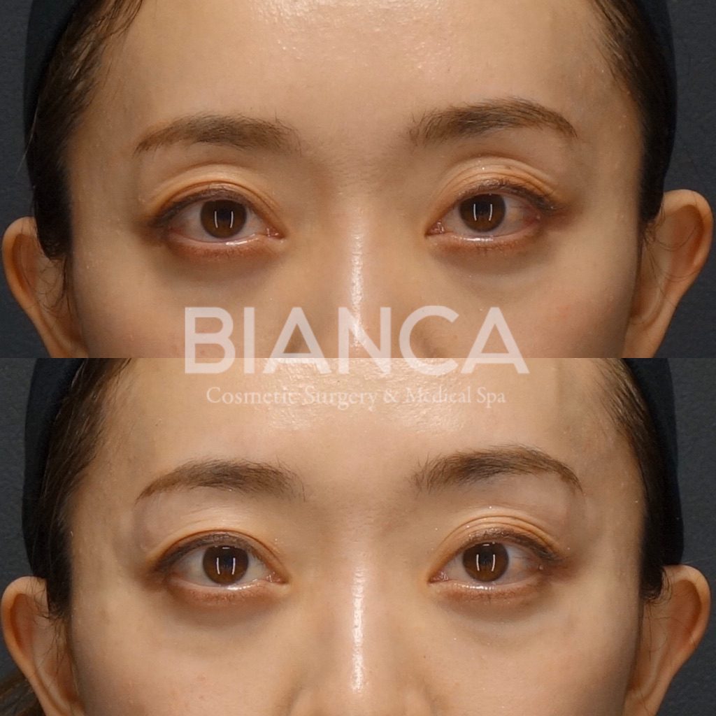 目の上のくぼみの原因と治療法を解説！ヒアルロン酸・眉下切開・眼瞼下垂（MT法）あなたに合うのはどれ？【BIANCA CLINIC】