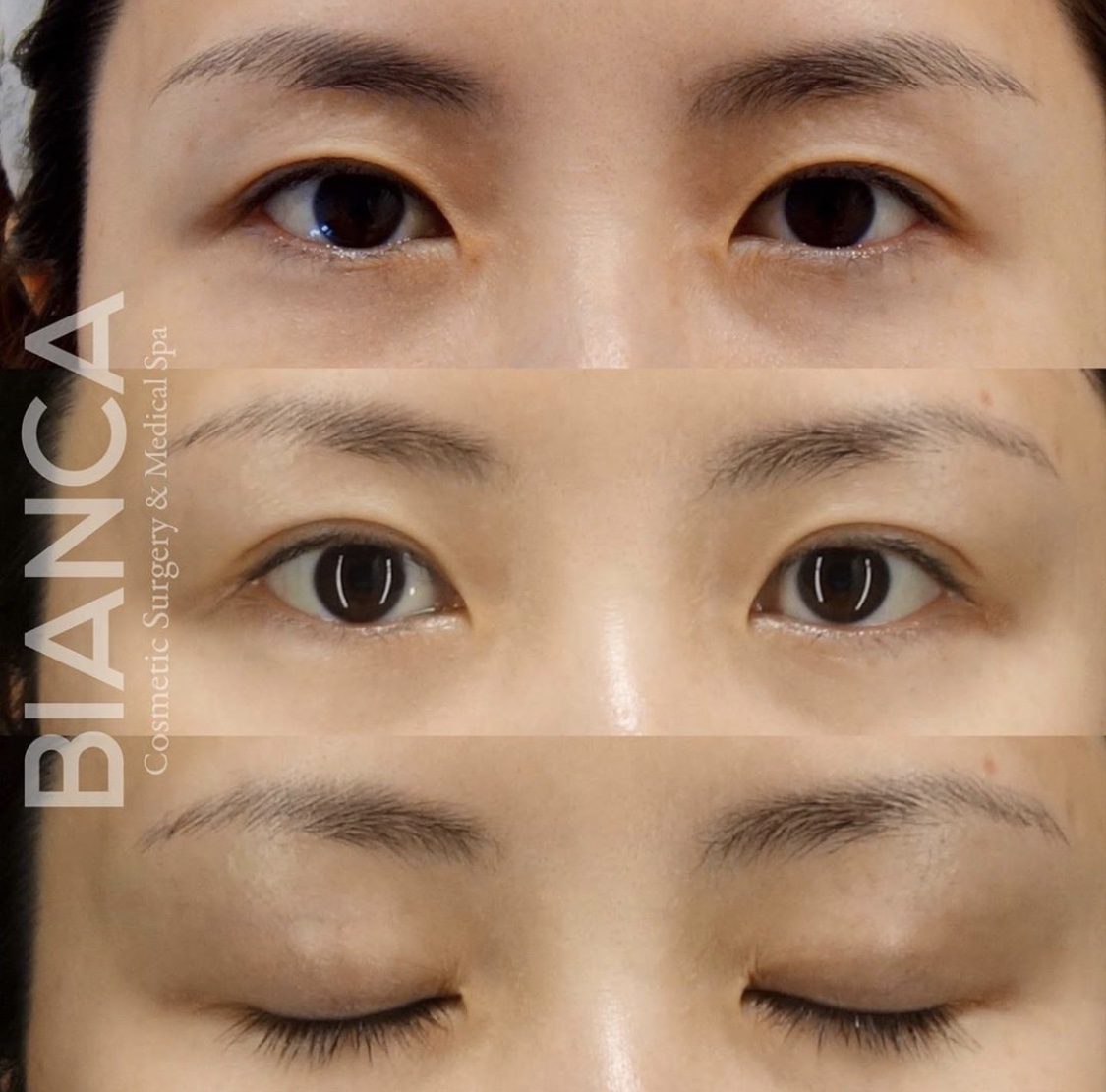 二重埋没法を比較！2点留め・4点留め・クロスリンク・MT法でダウンタイムと持続力はどう違う？【医師監修】