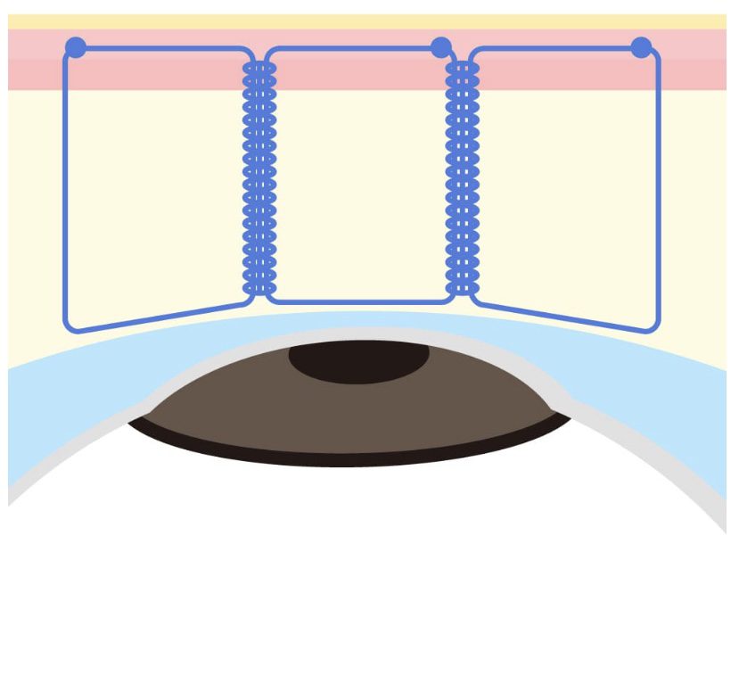 クロスリンクのイメージ-二重埋没法を比較！2点留め・4点留め・クロスリンク・BAメソッド・MT法でダウンタイムと持続力はどう違う？【医師監修】