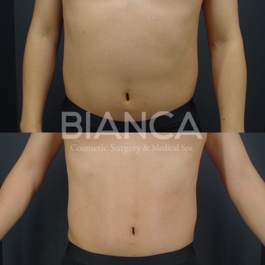 エムスカルプト（EMSCULPT）