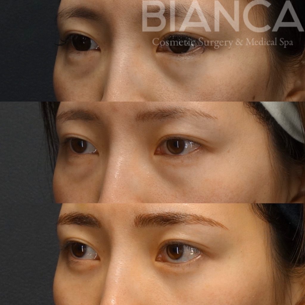 目の下クマたるみ取り×ヒアルロニダーゼによる目元治療で目の下スッキリした症例写真・ビフォーアフター