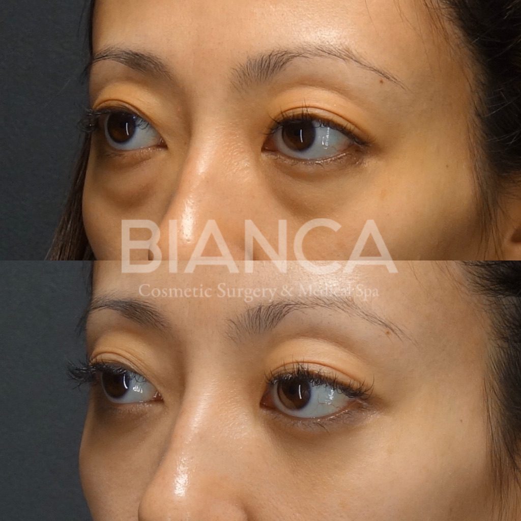 目の下クマ・たるみ取り（経結膜脱脂術）で目元がスッキリした症例写真・ビフォーアフター