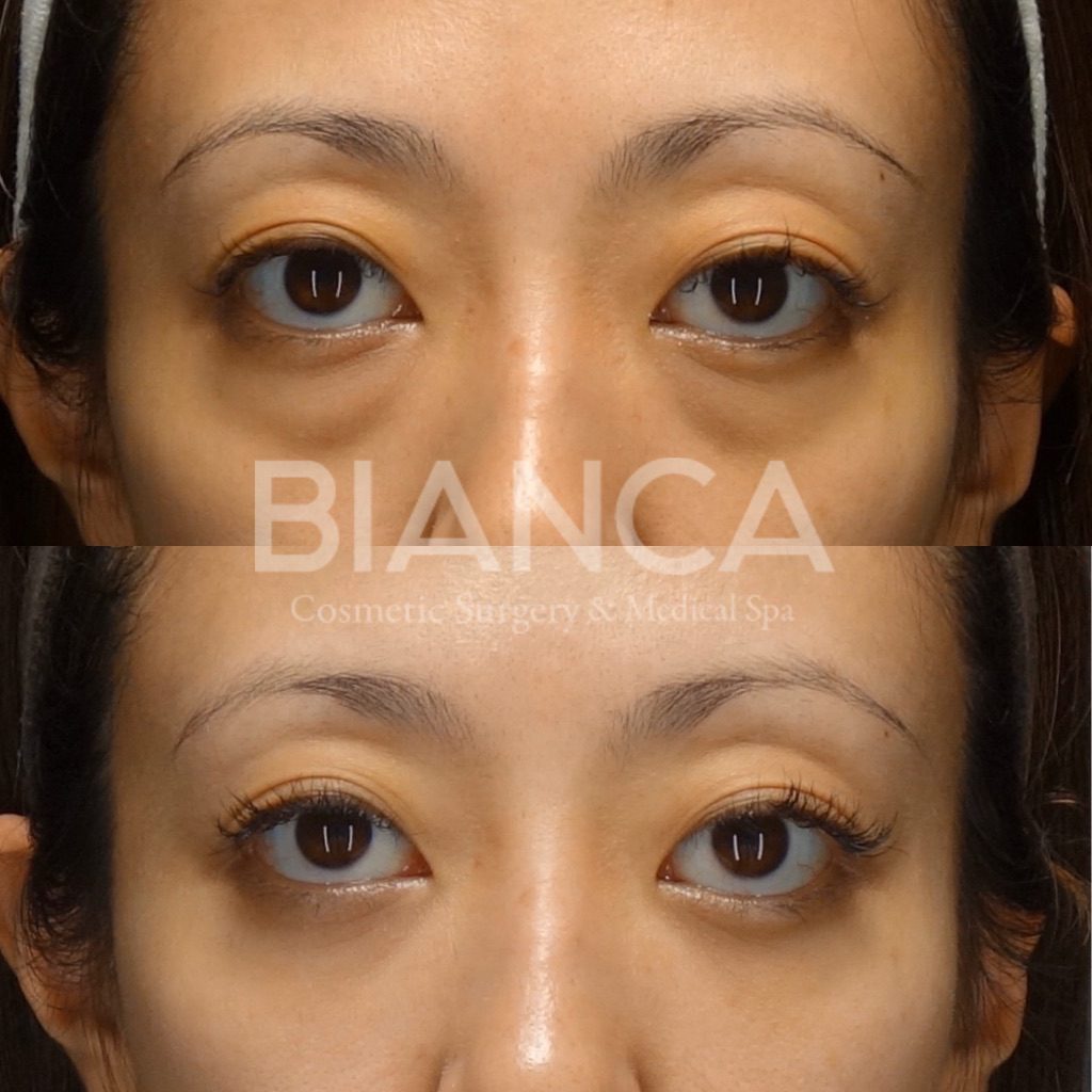 目の下クマ・たるみ取り（経結膜脱脂術）で目元がスッキリした症例写真・ビフォーアフター