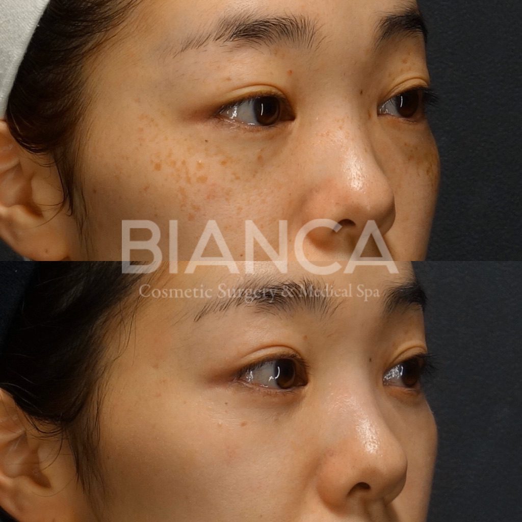 ピコスポット（そばかす）×目の下クマたるみ取りの併用症例