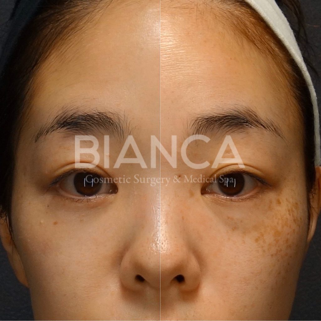 ソバカス×クマ　同時治療