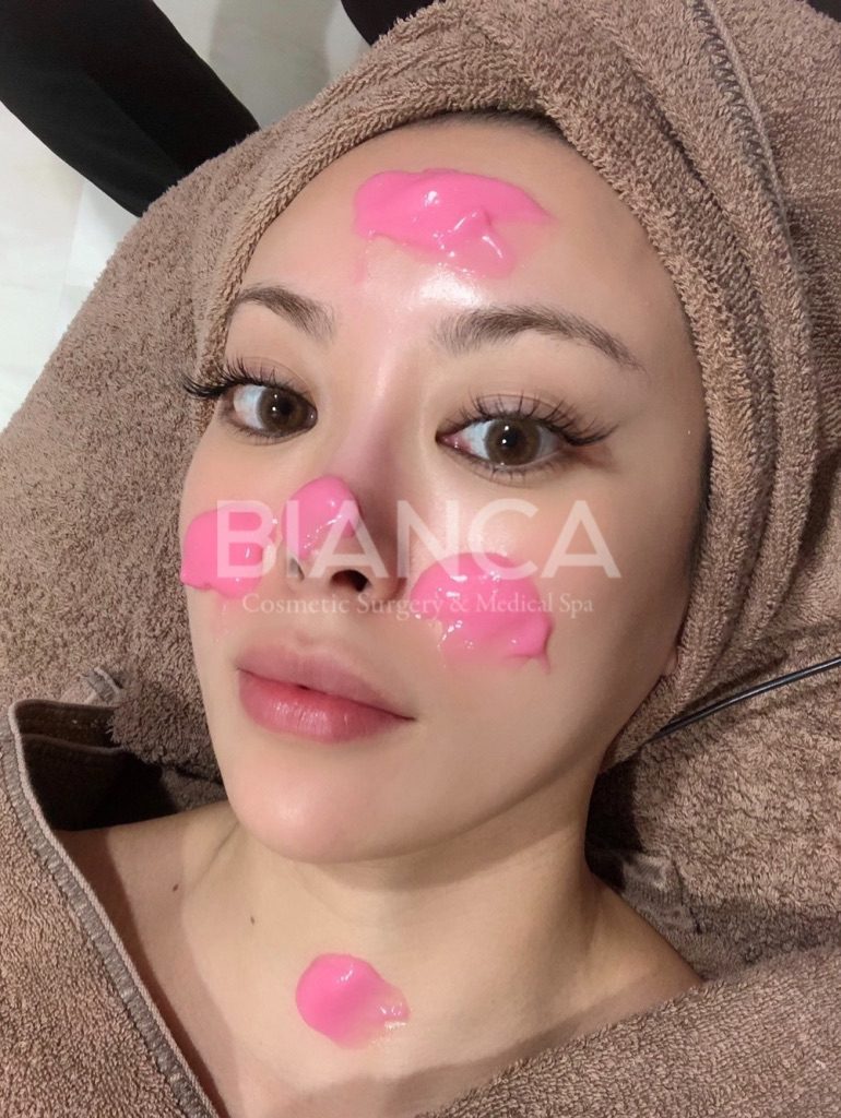 メソナJ（MESONA-J／メソポレーション）