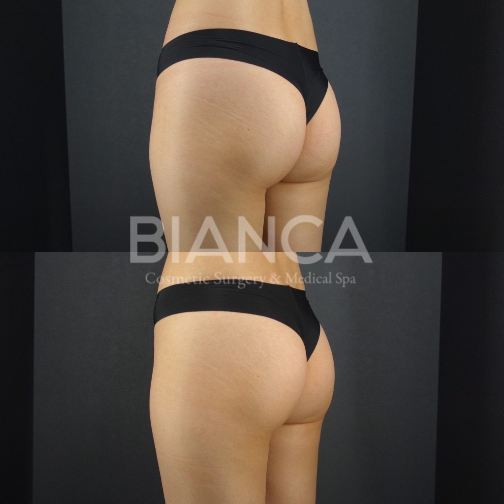 EMSCULPT®︎（エムスカルプト）によるメディカルボディメイク症例写真・ビフォーアフター