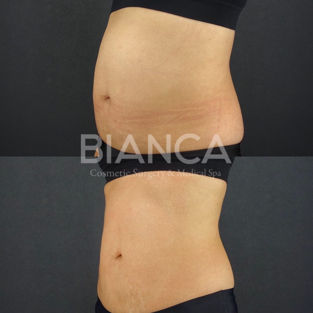 EMSCULPT®︎（エムスカルプト）によるメディカルボディメイク症例写真・ビフォーアフター