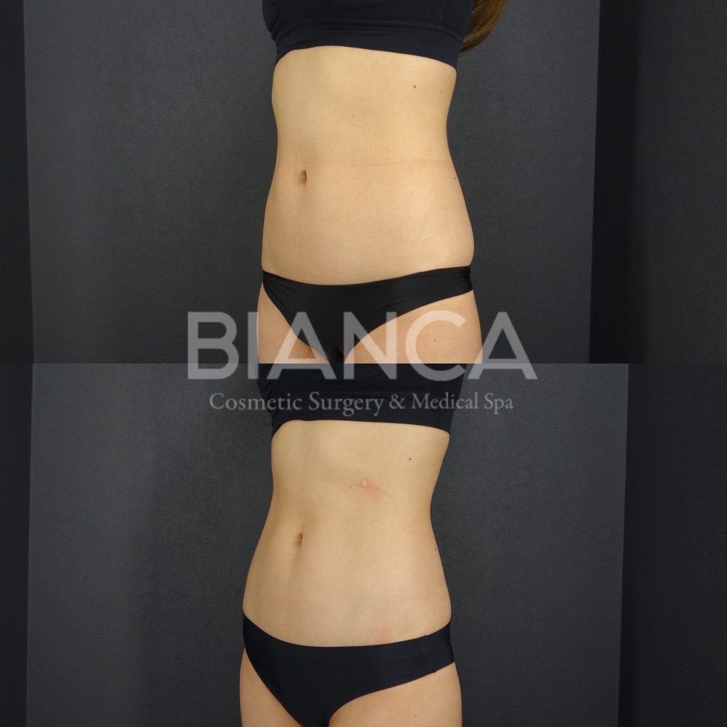 EMSCULPT®︎（エムスカルプト）によるメディカルボディメイク症例写真・ビフォーアフター