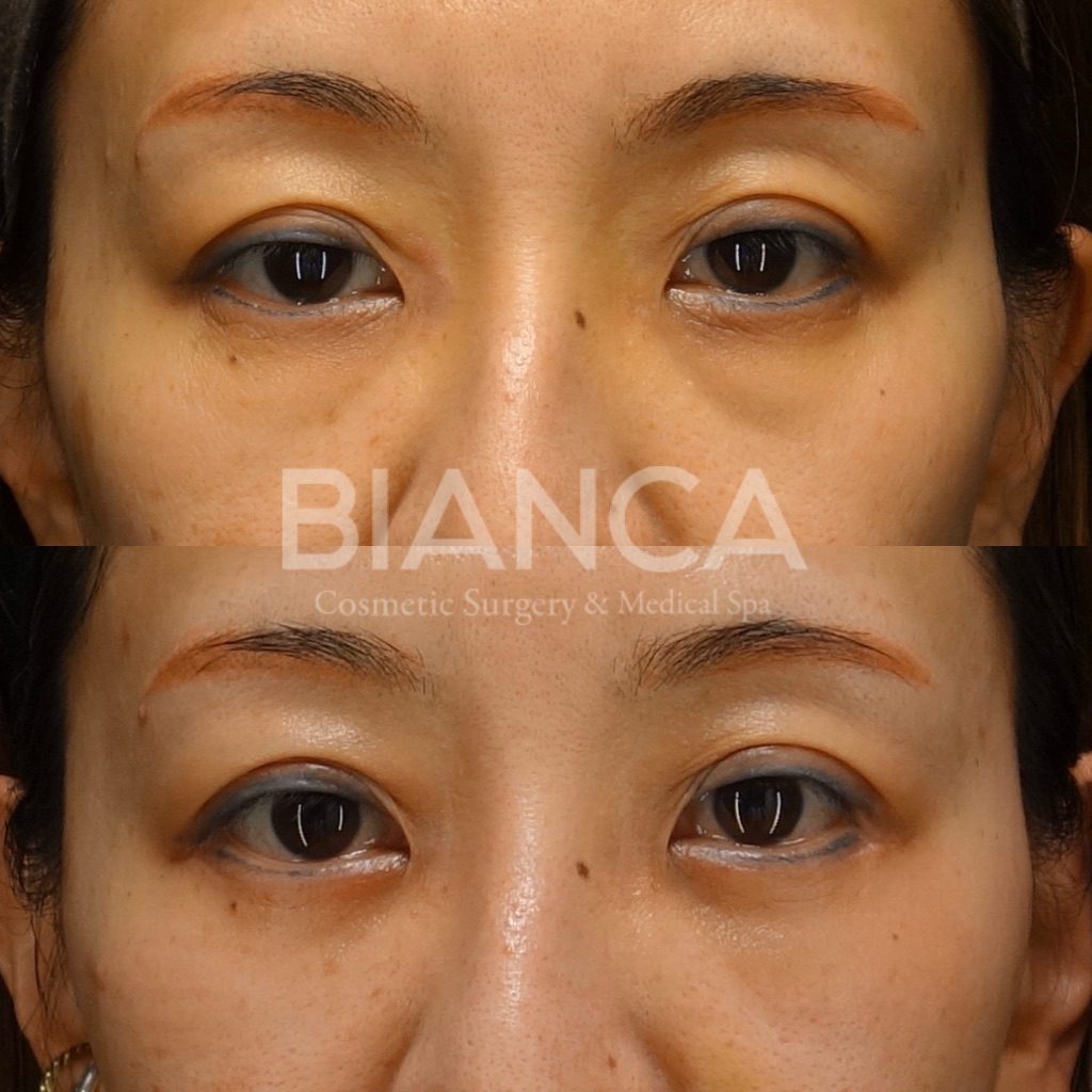 下瞼たるみ＋脂肪取り