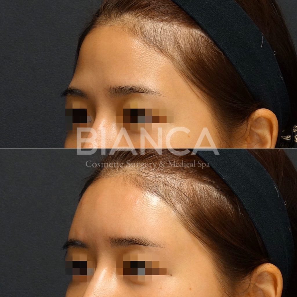 ヒアルロン酸注入