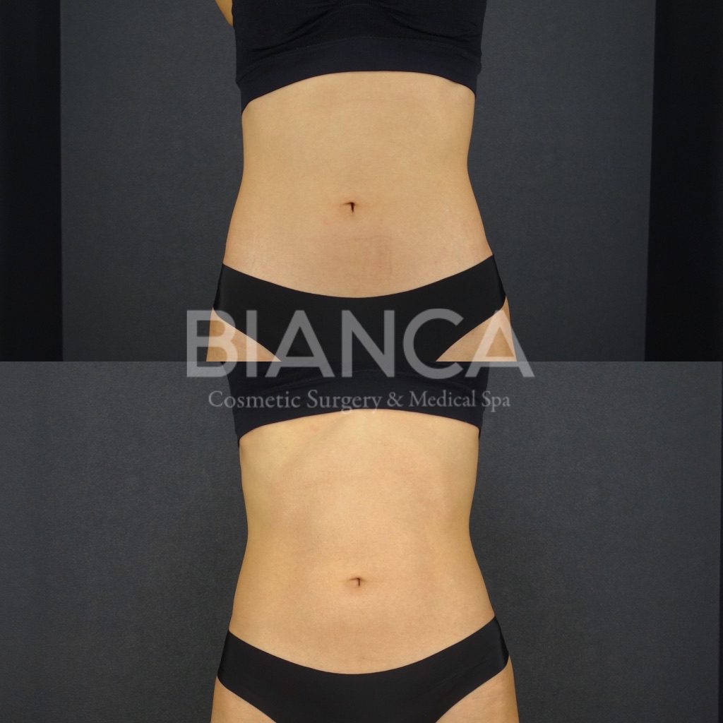 EMSCULPT®︎（エムスカルプト）によるメディカルボディメイク症例写真・ビフォーアフター