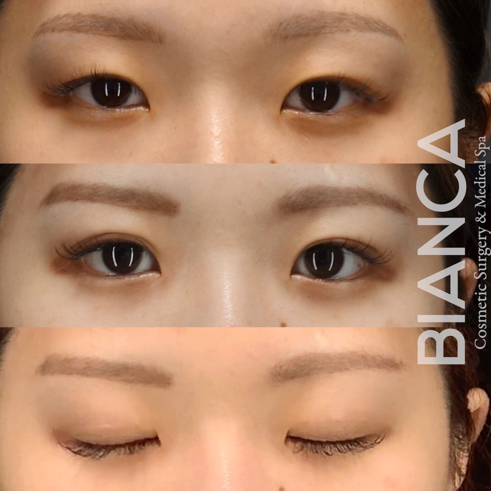 クロスリンクで二重を作成したモニター様上：術前、中央：術後1ヶ月、下：術後1ヶ月（閉瞼時）