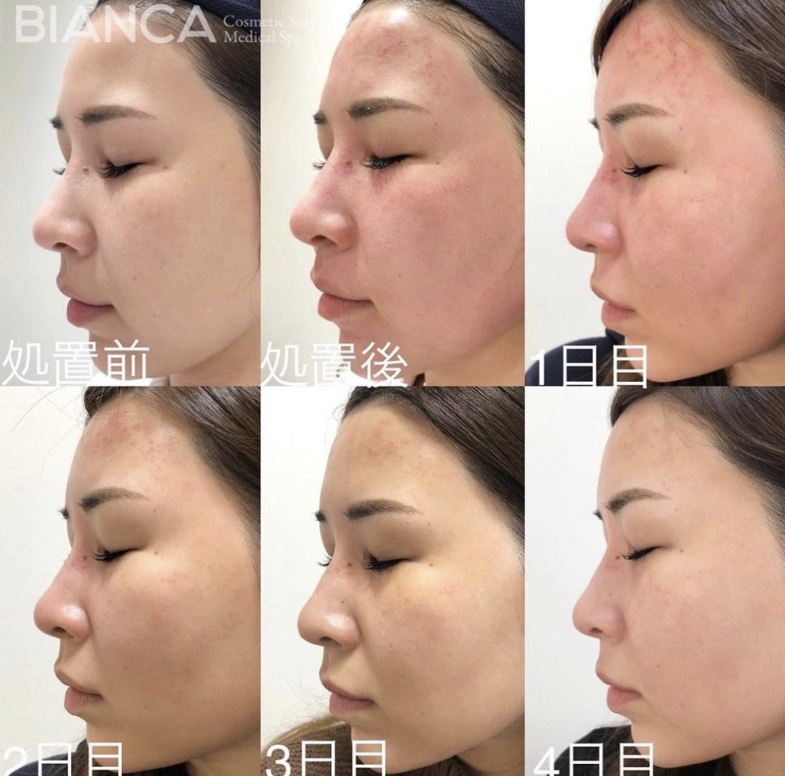 ヴァンパイアフェイシャルのダウンタイムは？赤みや皮むけを写真で解説