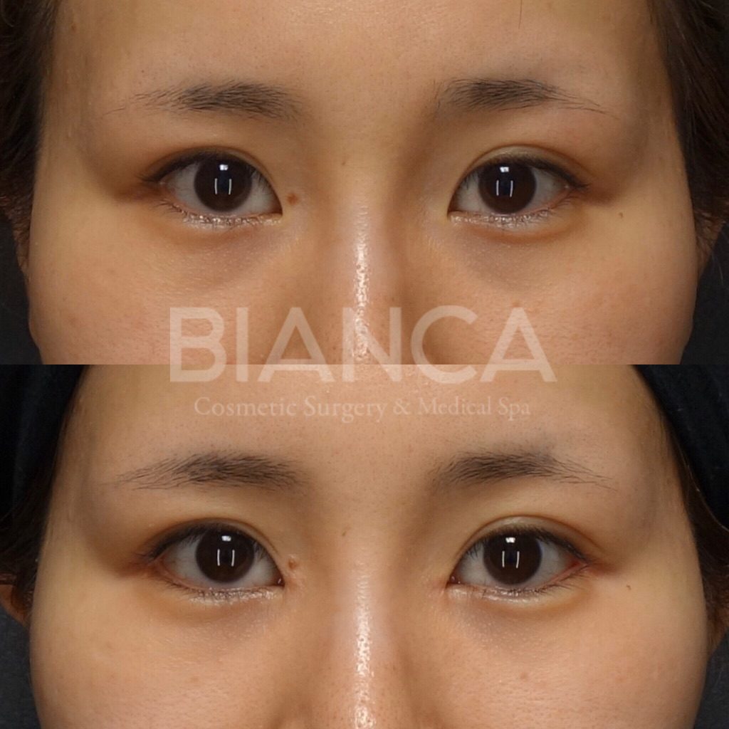 目元の複合治療の症例写真・ビフォーアフター