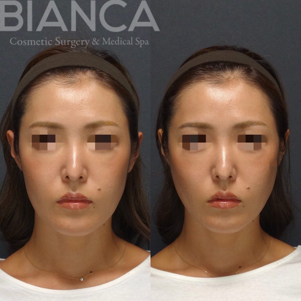 スレッドリフト