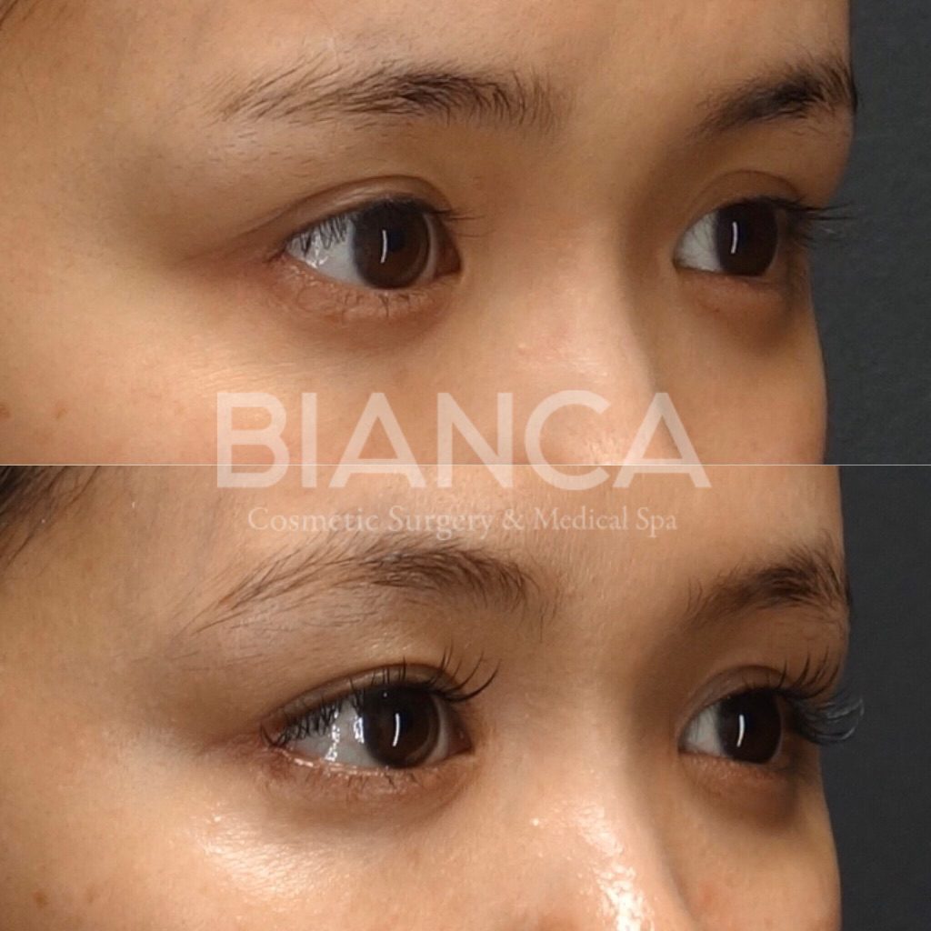 瞼が腫れぼったい！原因と治療法をタイプ別に解説！【医師監修】