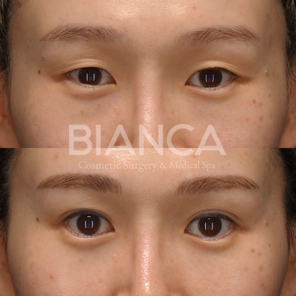 目元の複合治療の症例写真・ビフォーアフター