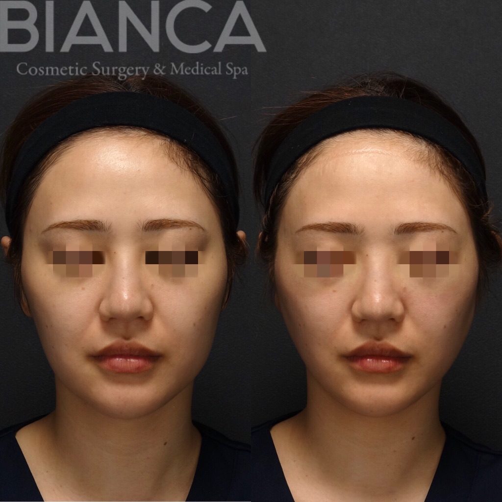 スレッドリフト