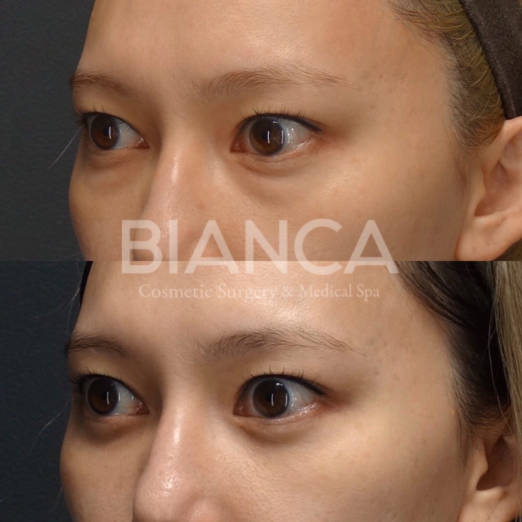 目の下クマ・たるみ取り（経結膜脱脂術）で目元がスッキリした症例写真・ビフォーアフター