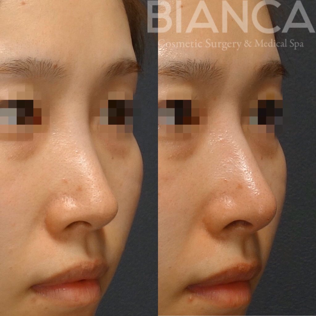 鼻のヒアルロン酸を他院修正