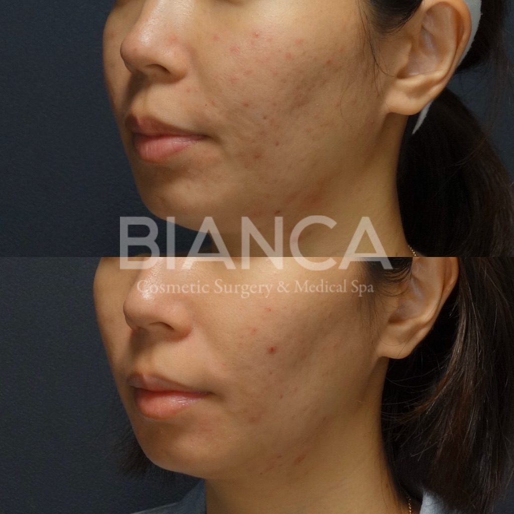 ハイドラフェイシャル（Hydrafacial）×ロアキュタン（イソトレチノイン）によるニキビ治療の症例写真・ビフォーアフター