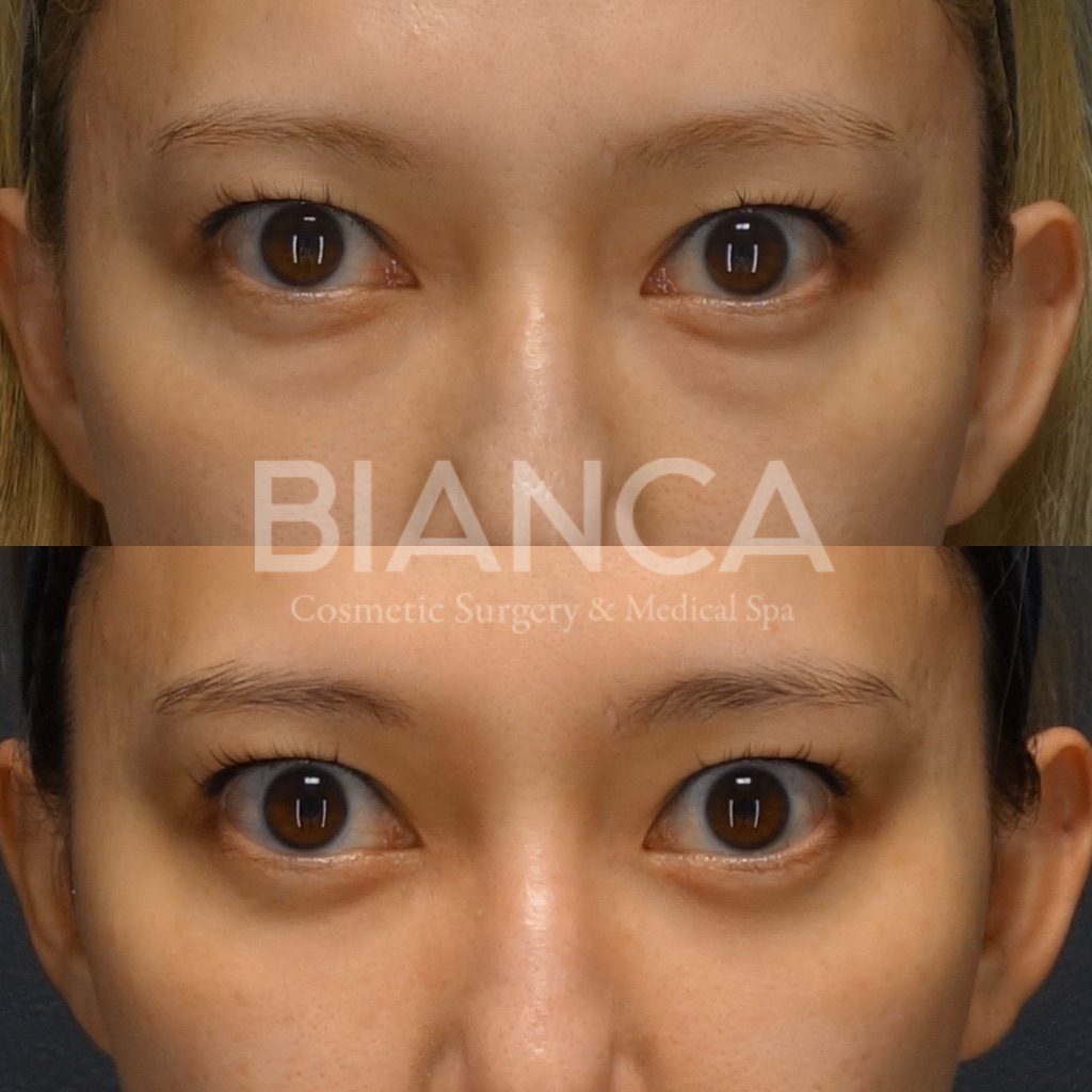 目の下クマ・たるみ取り（経結膜脱脂術）で目元がスッキリした症例写真・ビフォーアフター