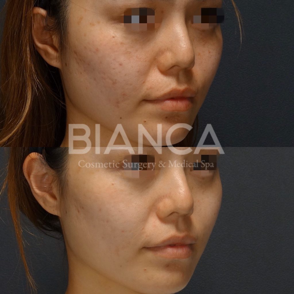 ピコシュアを用いたピコスポット＋ピコトーニングによるシミそばかす・美肌施術症例