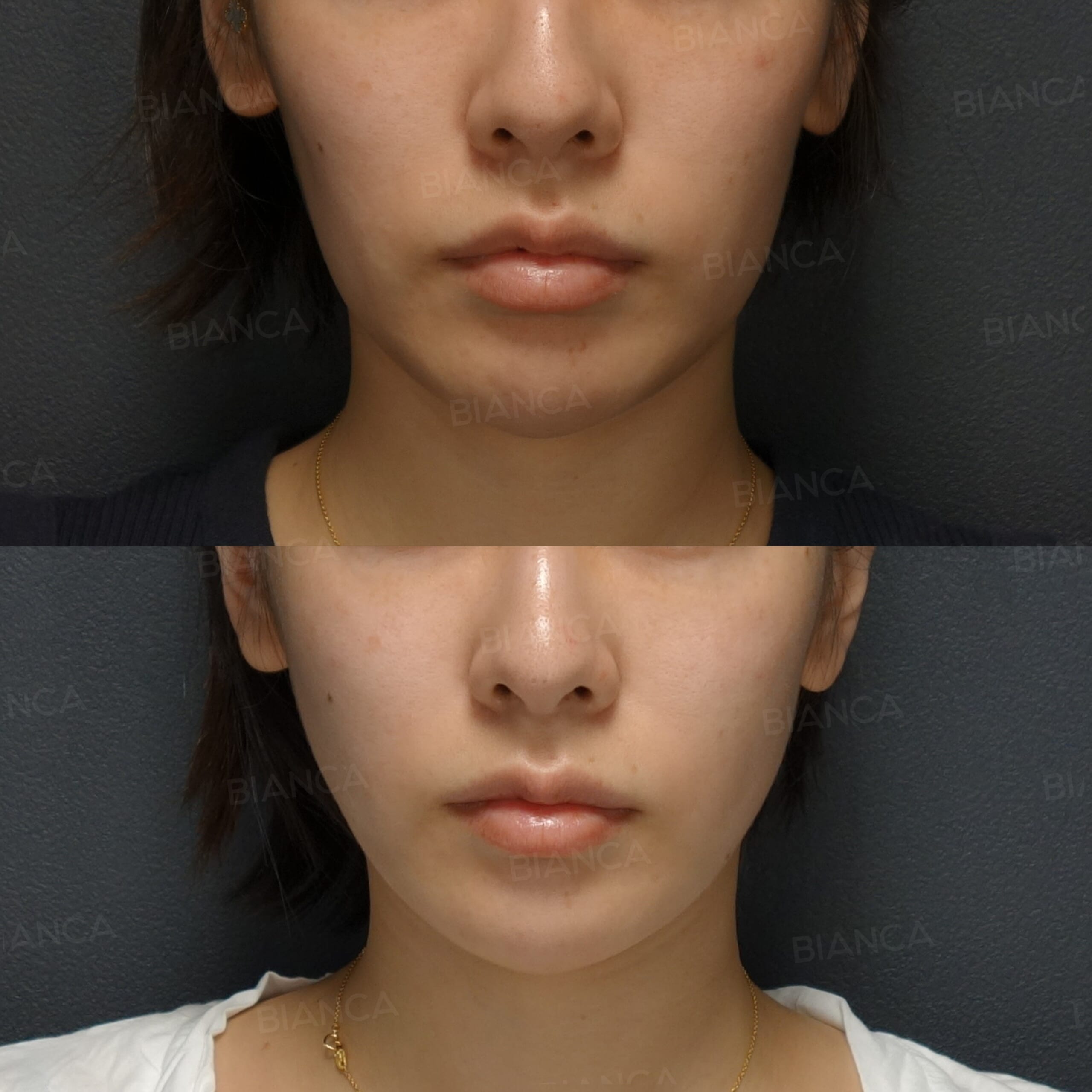 スレッドリフト