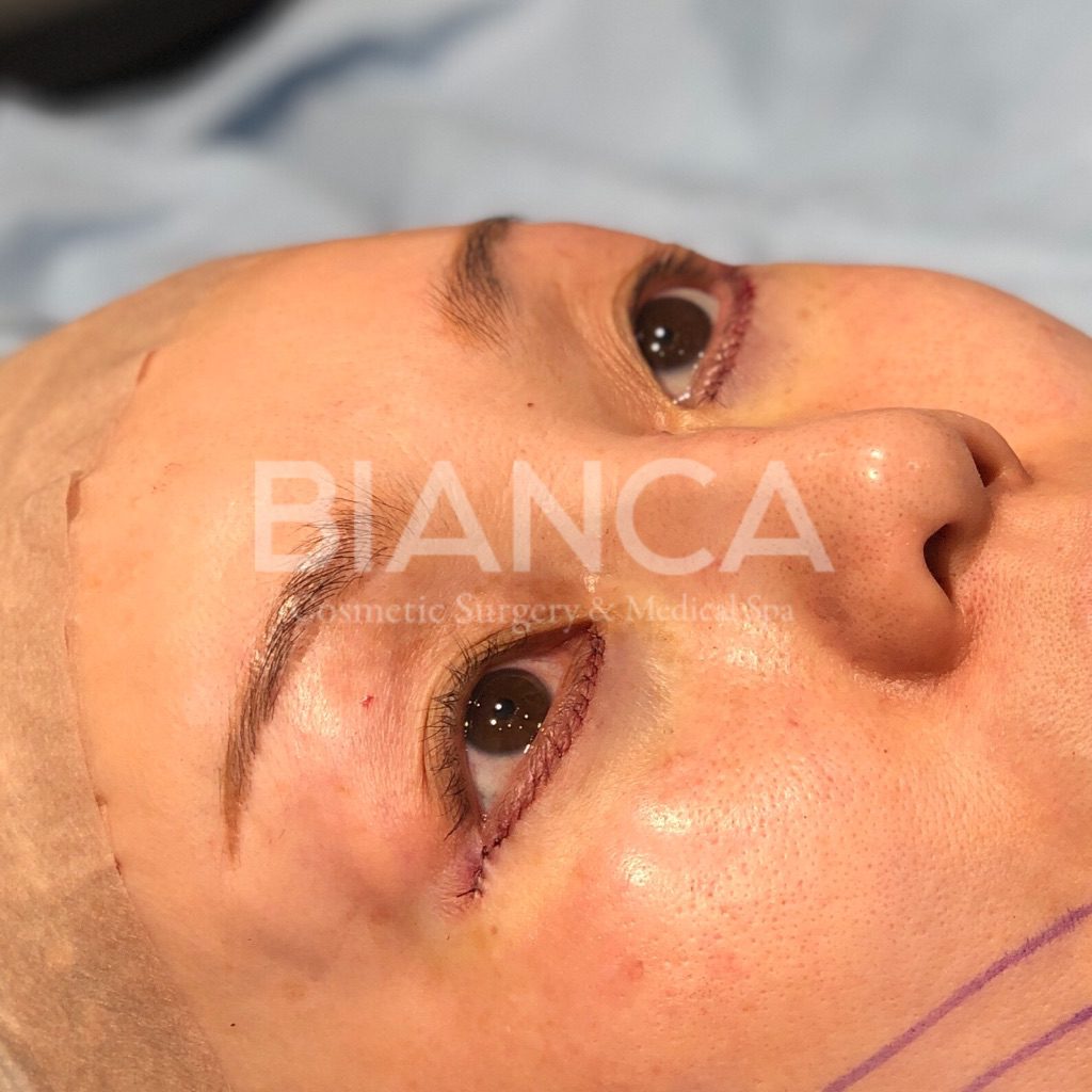 下瞼たるみ＋脂肪取り