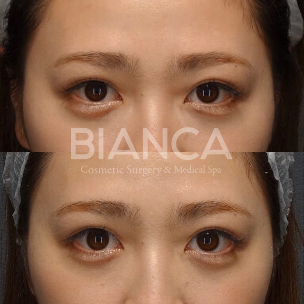 涙袋の左右差は修正できる？原因と治療法をビアンカドクターが解説