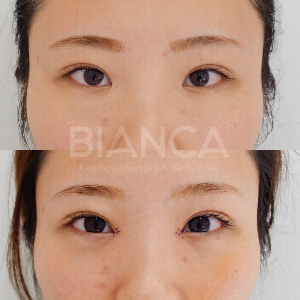 目元をクールに可愛く。目頭切開と目上切開ってなに。目頭切開で目の横幅を広げて目を大きく見せる・並行二重に整えた症例写真・ビフォーアフター