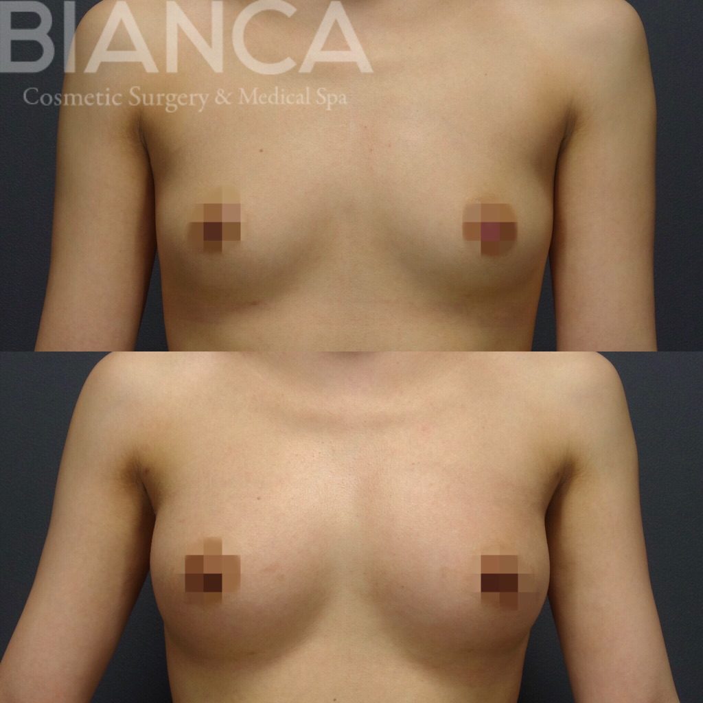 コンデンスリッチ豊胸（CRF豊胸）症例写真・ビフォーアフター