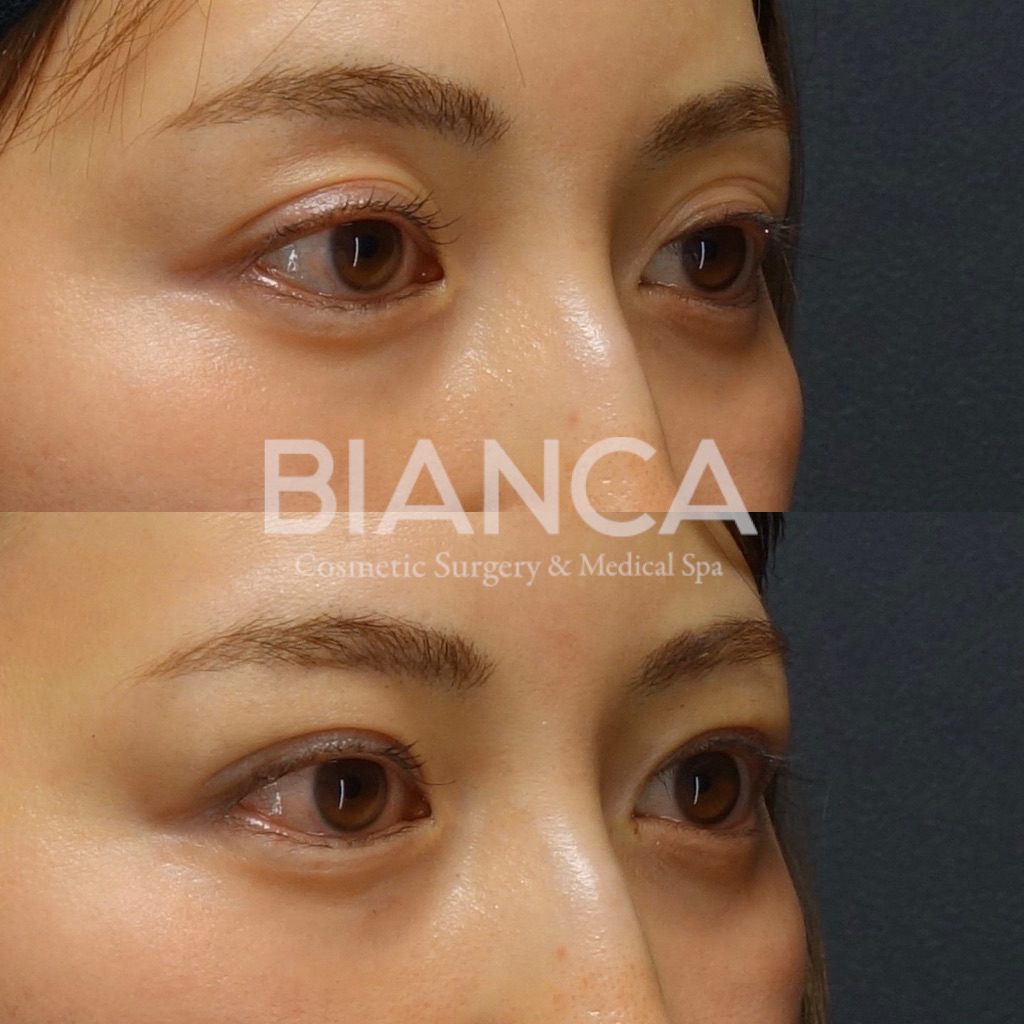 切らない眼瞼下垂（MT法） による二重整形の症例写真・ビフォーアフター