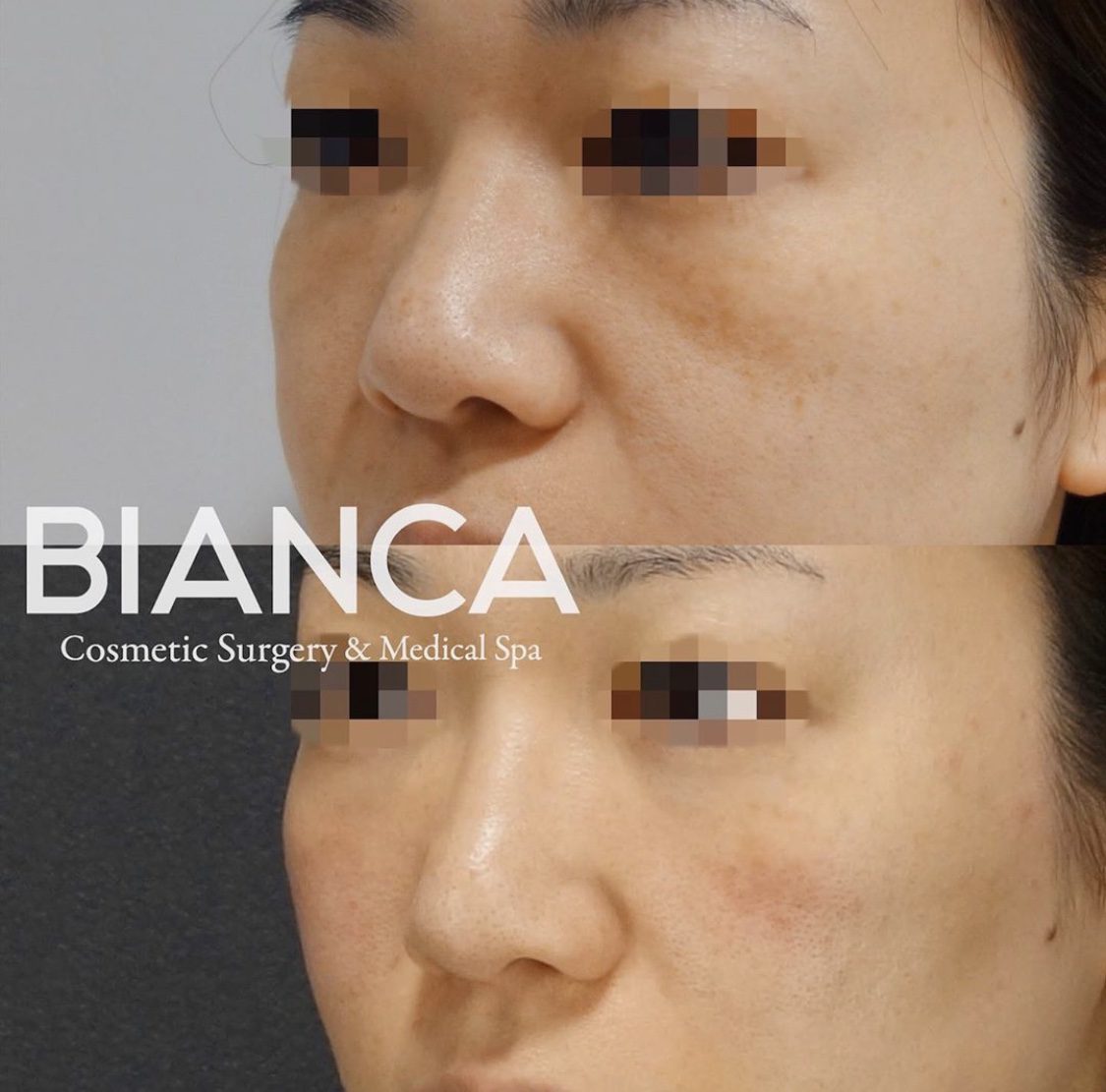 ゴルゴラインにヒアルロン酸注射でアプローチ【症例紹介】