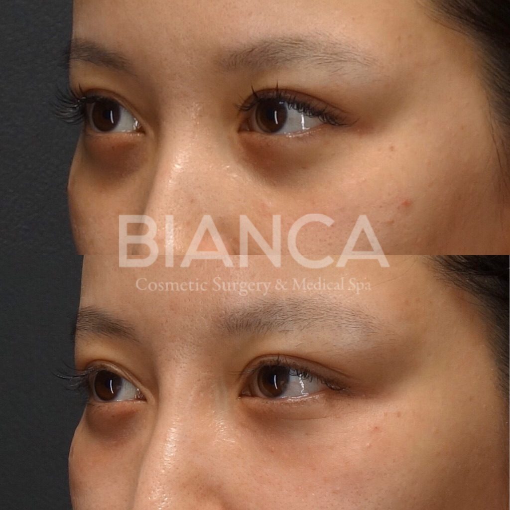 ベビーコラーゲンによる目の下の凹み・クマ・ちりめんジワなどの改善症例・ビフォーアフター 目の下の悩みにベビーコラーゲン！くぼみ・ちりめんジワを自然に整える注入治療【ビアンカクリニック】