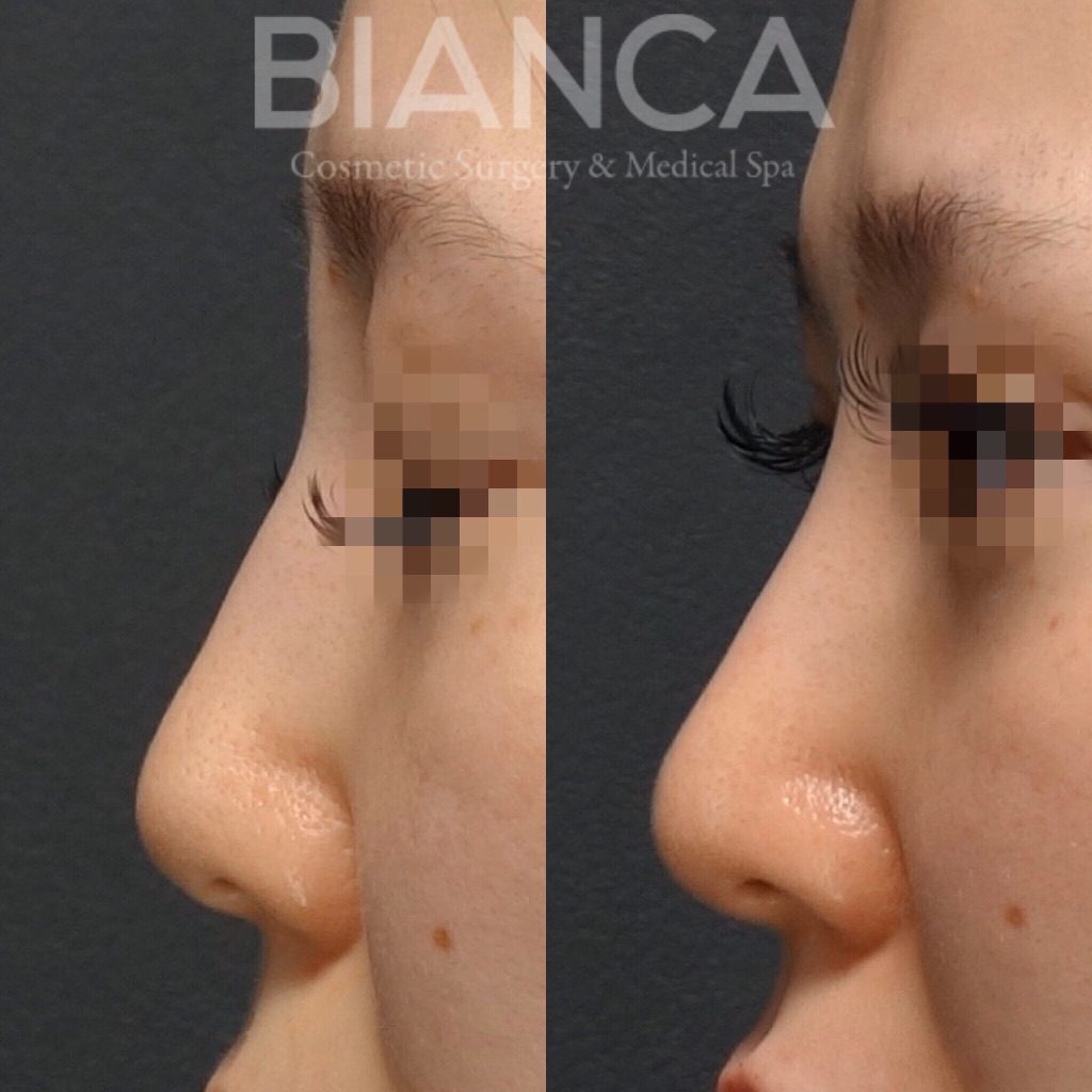 ヒアルロン酸の入ったお鼻を修正