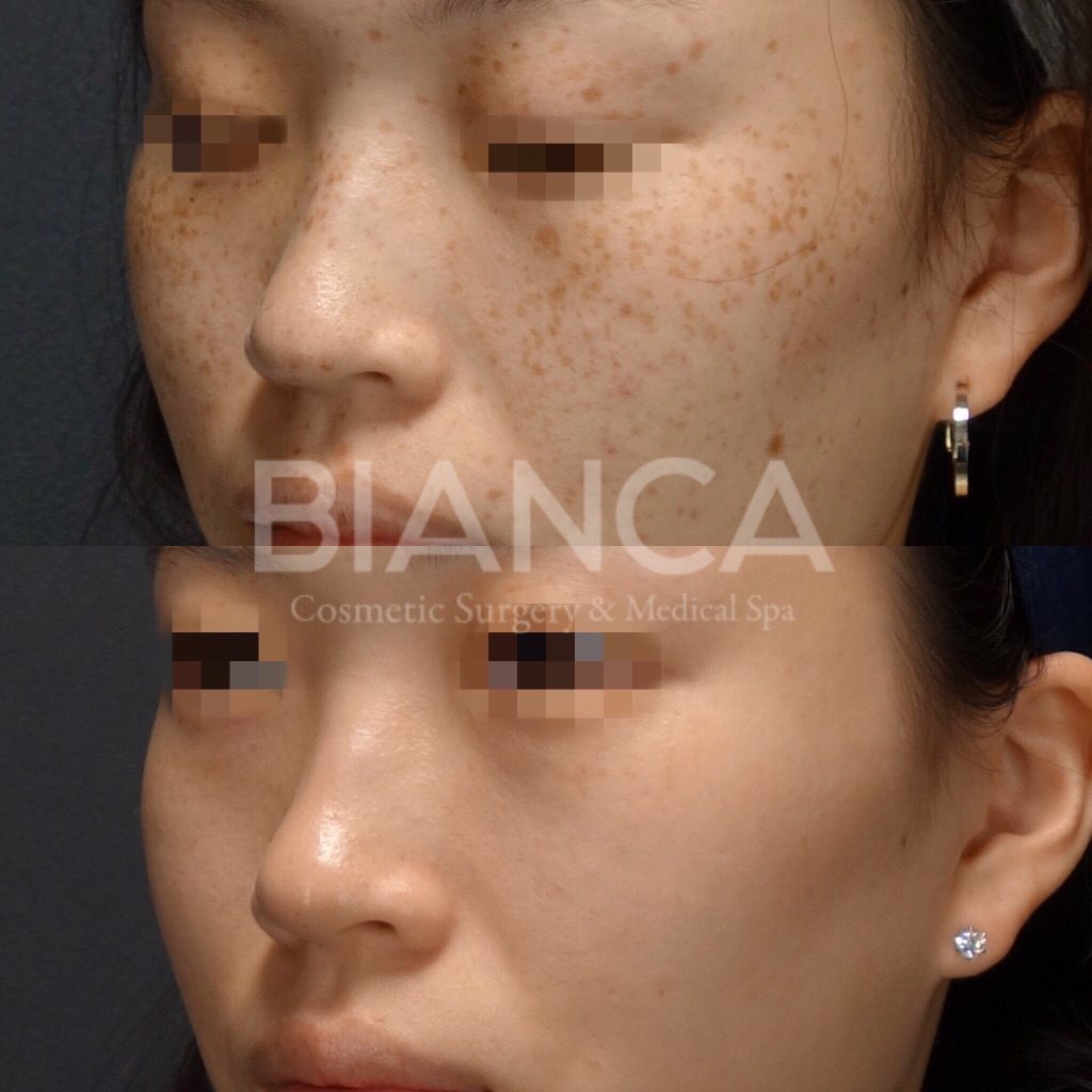 PICO SPOT（ピコスポット）＋ピコトーニングによるそばかす治療症例