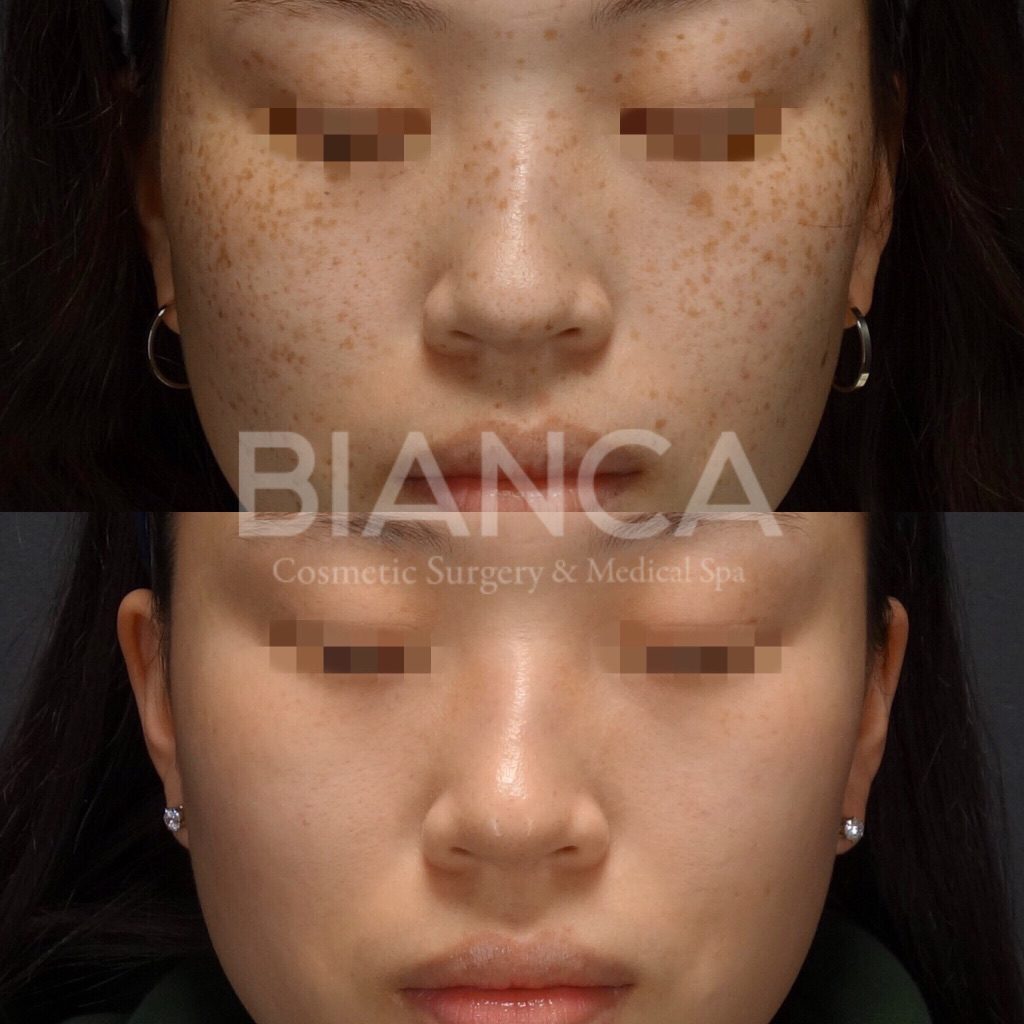 ピコシュアでのピコスポット・ピコトーニングによるシミ・そばかす治療の症例写真