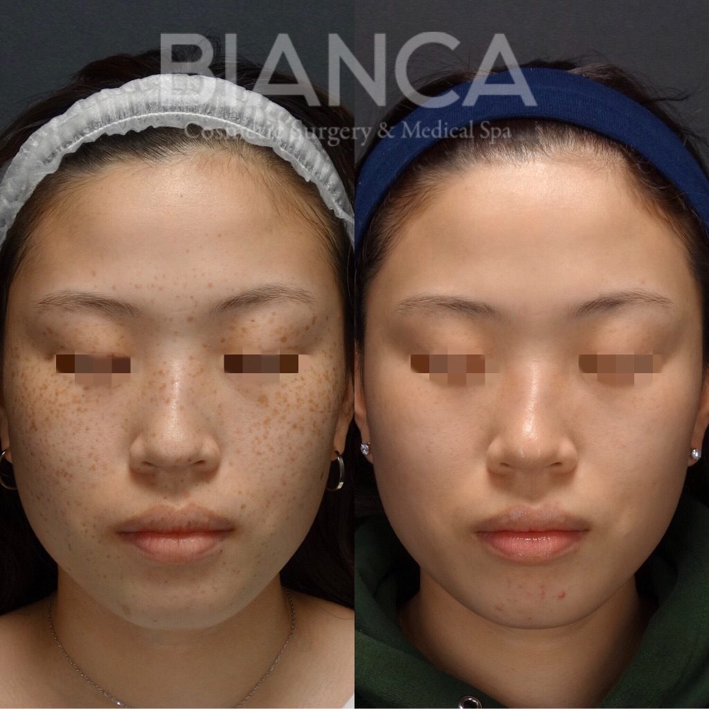 ピコシュアでのピコスポット・ピコトーニングによるシミ・そばかす治療の症例写真