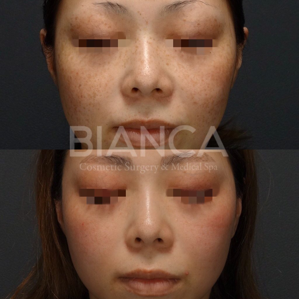 ピコシュアでのピコスポット・ピコトーニングによるシミ・そばかす治療の症例写真