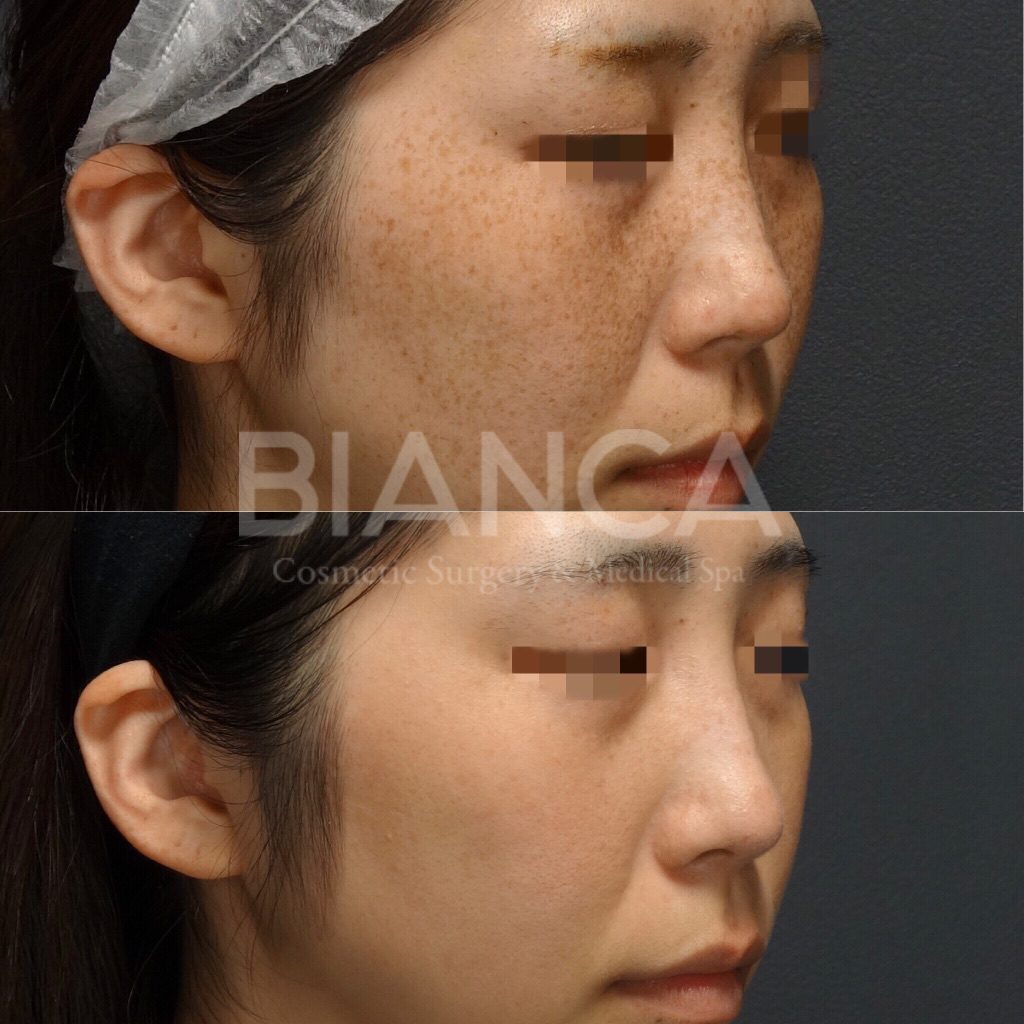 ピコシュアでのピコスポット・ピコトーニングによるシミ・そばかす治療の症例写真