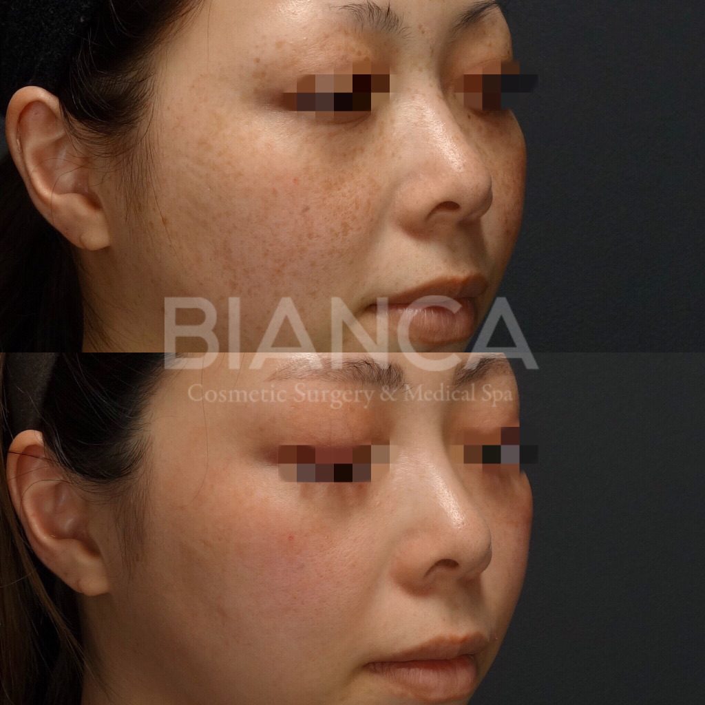 ピコシュアでのピコスポット・ピコトーニングによるシミ・そばかす治療の症例写真