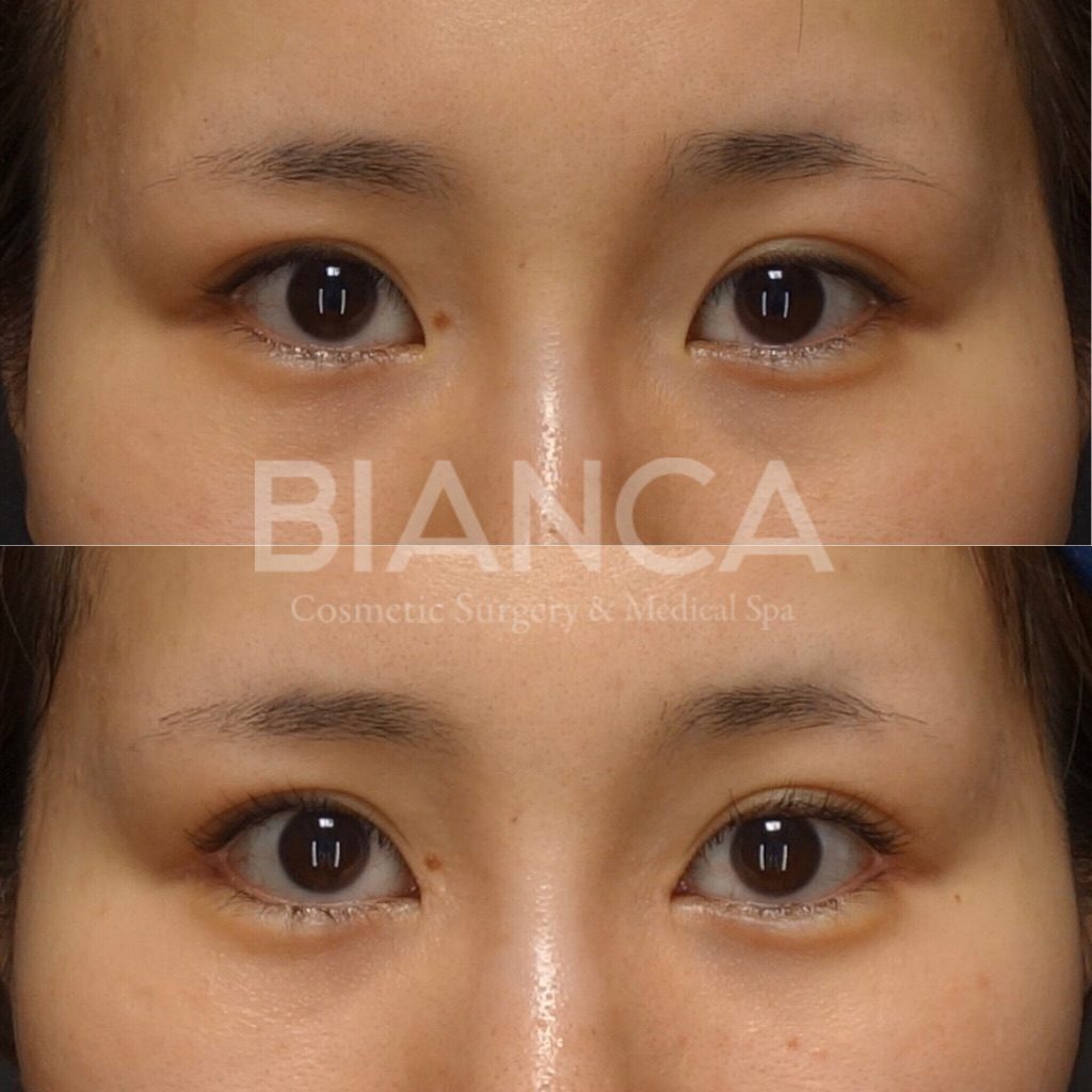 目頭切開×目尻切開×グラマラスライン形成