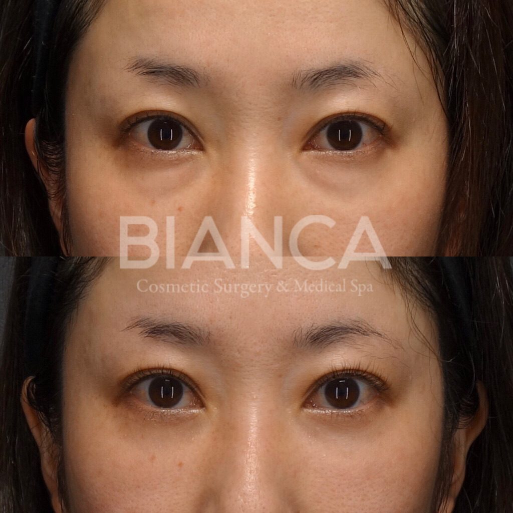 目の下クマ・たるみ取り（経結膜脱脂術）で目元がスッキリした症例写真・ビフォーアフター クマ取り（経結膜脱脂術）の経過は？腫れ・内出血・仕上がりを医師が解説【ビアンカクリニック】