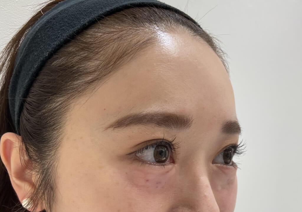 スネコス💉ダウンタイム　術前⇒術直後