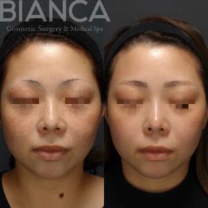 ピコシュアでのピコスポット・ピコトーニングによるシミ・そばかす治療の症例写真