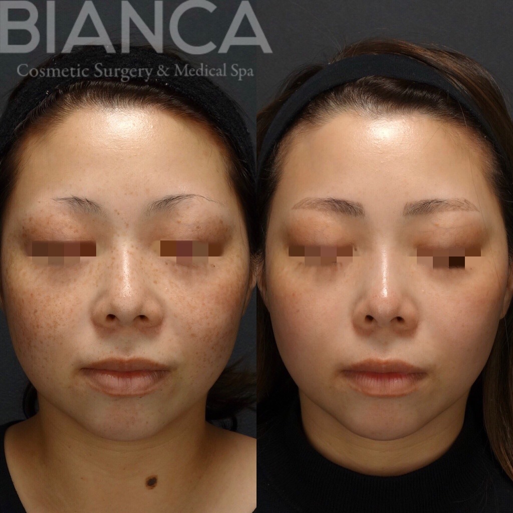 ピコトーニング（Pico Toning）